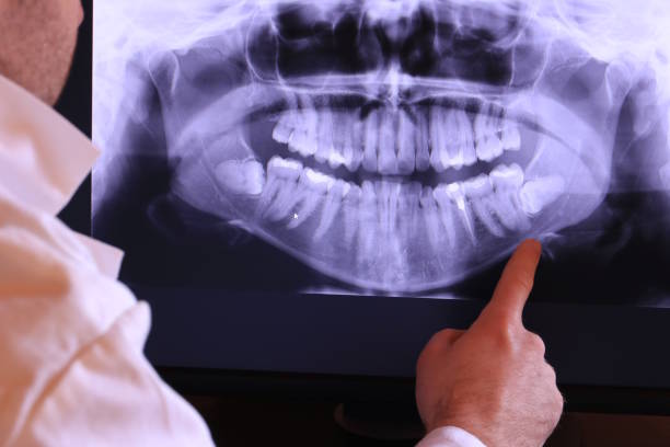 Best Emergency Tooth Extraction in Imperial, NE